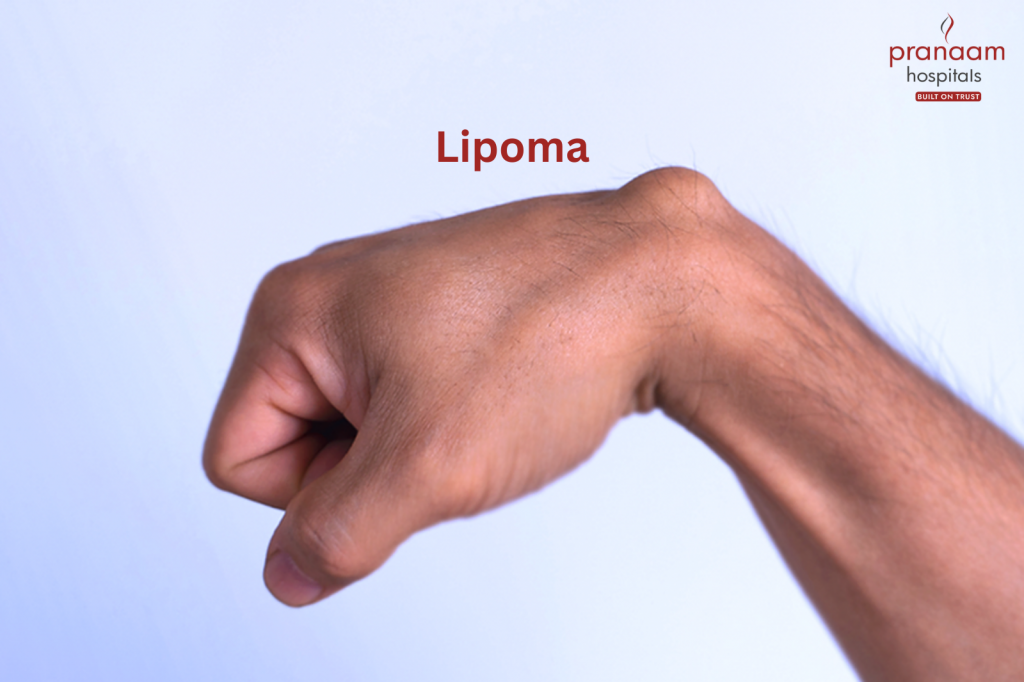 lipoma