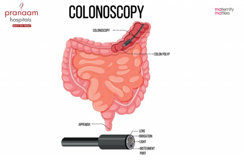 colonoscopy